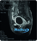 1 Día después del tratamiento