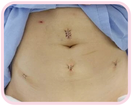 Cirugía laparoscópica